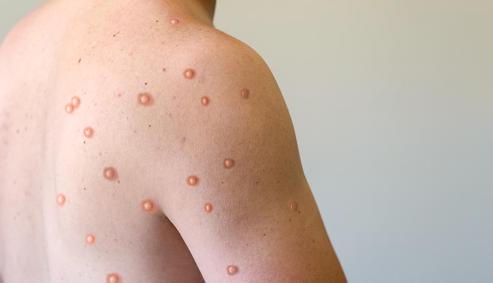 What is MPOX Disease image