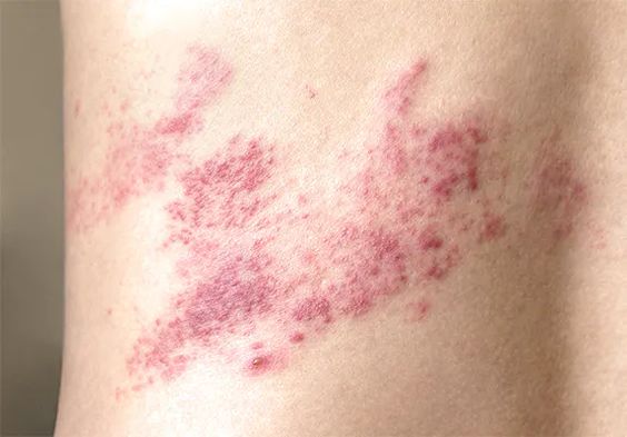 What is Shingles (Herpes Zoster Virus) Symptoms, Diagnosis, Treatment, and Prevention image